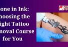Choosing the Right Tattoo Removal Course for You